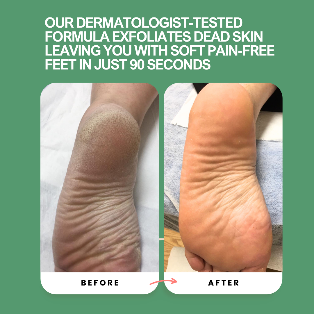 Tallora – Instant Foot Peeling Spray